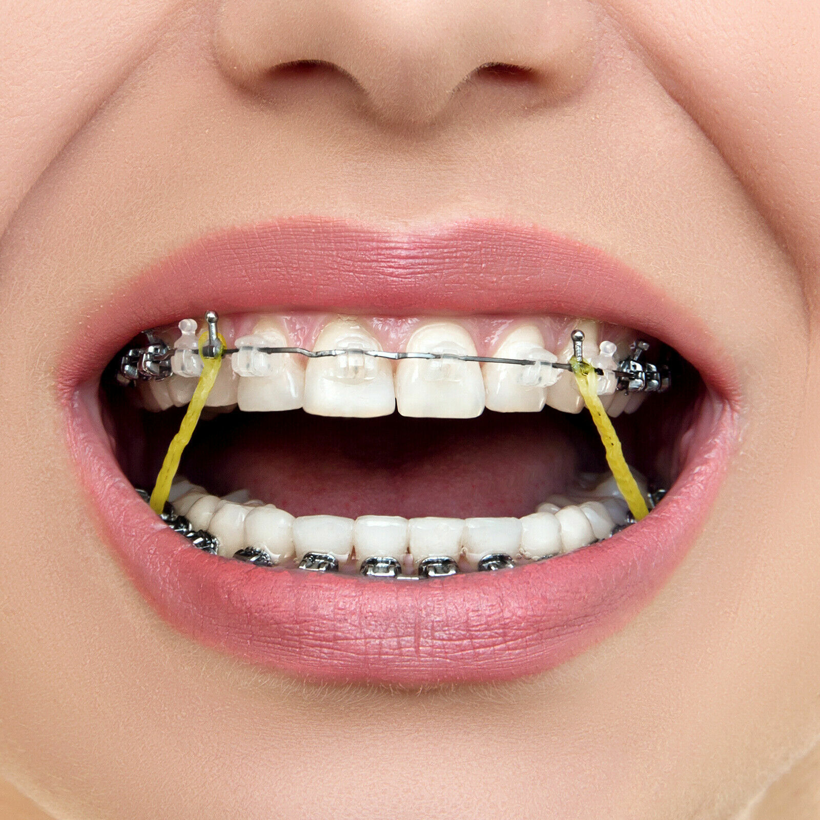 JMU Dental Orthodontic Elastics Intraoral Elastic Bands Latex Braces 100pcs/pk